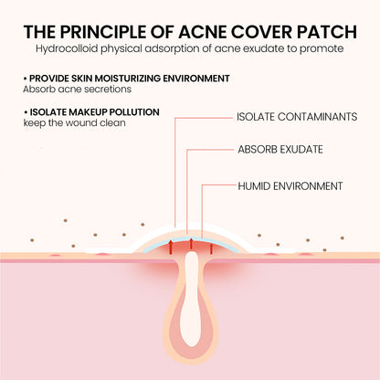 Anti-Acne Pimple Patches (200pcs)