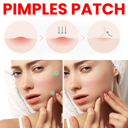 Anti-Acne Pimple Patches (200pcs)